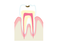 虫歯の進行具合と治療方法